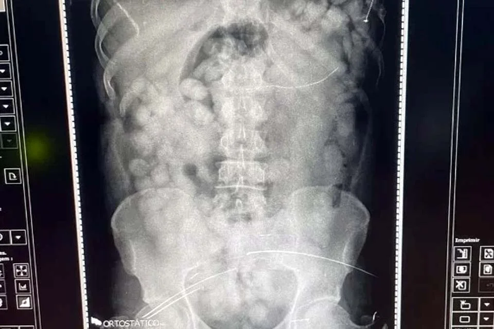 PF prende homem com mais de 150 cápsulas de cocaína no estômago em aeroporto do PA
